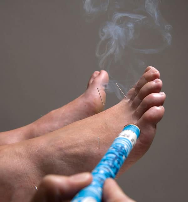 The use of Moxibustion for breech babies Acumamas